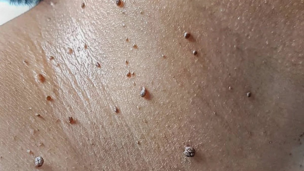 Another miracle happened this morning.

Skin tag falls off after applying the pencil plant I recommended. 

Nature heals. 
#BackToEden