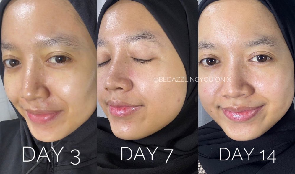 guys…. akhirnya ada peeling serum tapi yg murce 40ribuan, NO TINGLING, jadi aman buat pemula 👍🏻

hasilnya 60 detik, sebaceous fillaments mendingan bgt, ini progressku gak expect se ok ini