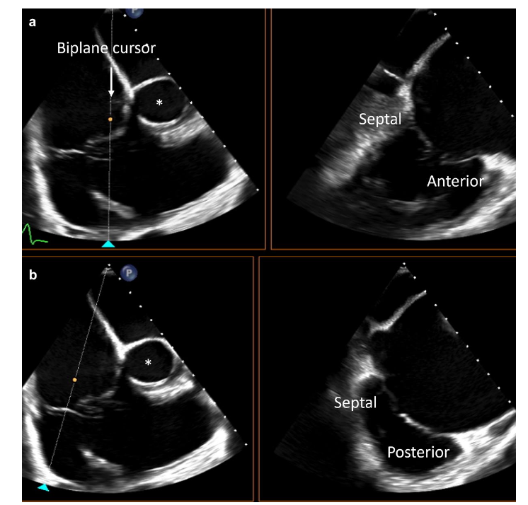 Revisión sobre la evaluación ecocardiográfica de la válvula tricúspide de cara a su reparación‼️‼️
journals.sagepub.com/doi/full/10.11…

📘Lee el análisis del artículo en nuestro blog: secce.es/los-10-mandami…