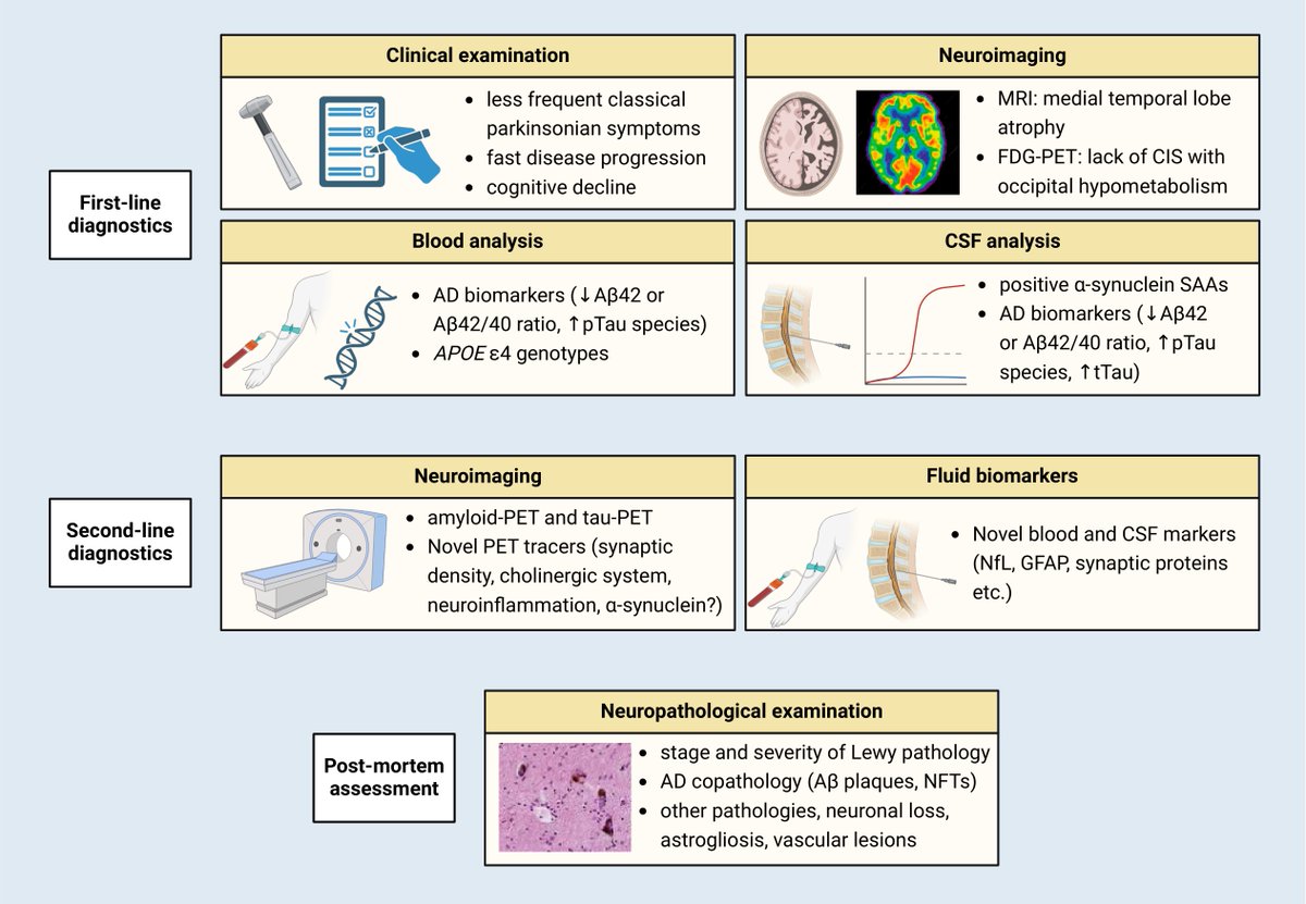 Brain1878's tweet photo. Barba et al. review the co-occurrence of Alzheimer's disease and Lewy body disease pathologies, and consider the diagnostic and prognostic value of neuroimaging and fluid biomarkers. https://t.co/M4GgccTbt2 https://t.co/VO8pFpSYL9