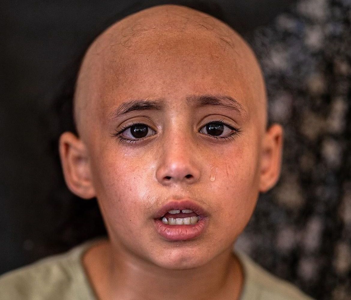 Abu_Salah9's tweet image. طفلة فقدت شعرها بشكل كامل بسبب الخوف والرعب الشديد من الجيش الاسرائيلي أثناء النزوح والقصف.

هؤلاء من سحقتهم إسرائيل ونسيهم الجميع، الحديث عنهم هو الأهم الآن.