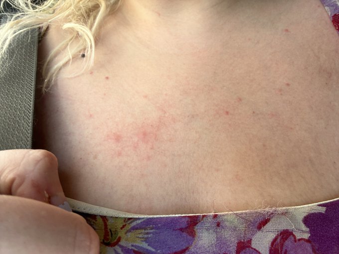 I have hives because roommate is trying to get me to see his dad with him 😂 https://t.co/Cp7YFfdHJH