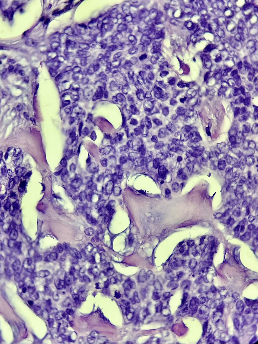 rqbittenc's tweet photo. Sclerodermiform BCC, aggressive variant,  characterized by its thick fibrotic stroma.

#bcc #dpath #dermpath #dermapath #skincancer #basalcell #carcinoma #pathtweet #path #pathology https://t.co/lSAYfWkOig