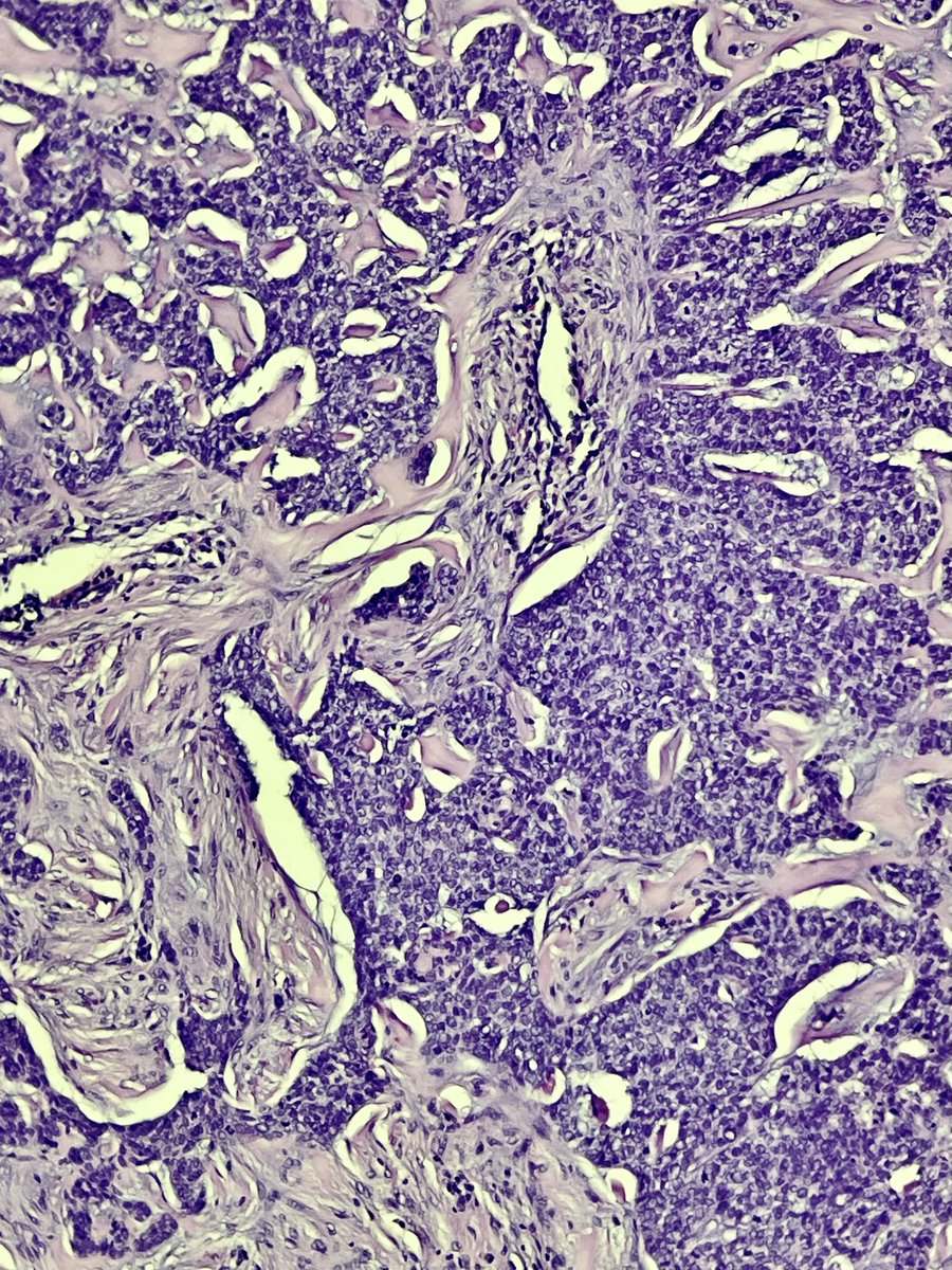 rqbittenc's tweet photo. Sclerodermiform BCC, aggressive variant,  characterized by its thick fibrotic stroma.

#bcc #dpath #dermpath #dermapath #skincancer #basalcell #carcinoma #pathtweet #path #pathology https://t.co/lSAYfWkOig