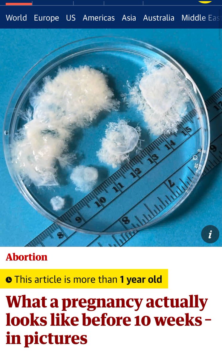 9 de cada 10 abortos se practican en el primer trimestre y lucen así: