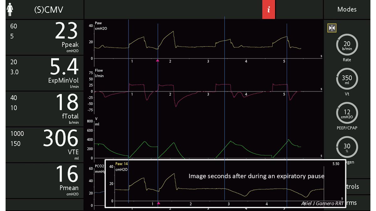 Ariel J Garnero (@arielg_rrt) on Twitter photo What is going on? What would you do next based on what you observe? <a href="/DocMusician/">Doc Musician</a> <a href="/DrMiguelIbarra1/">Dr. Miguel Ibarra-Estrada</a> <a href="/emireles_c/">Eduardo Mireles-Cabodevila</a> <a href="/CCF_PCCM/">CCF Pulmonary and Critical Care Fellows</a> <a href="/ATC_Ventilator/">Ben Fabry</a> <a href="/OfVentilation/">Society of Mechanical Ventilation</a> <a href="/critconcepts/">Critical Concepts</a> <a href="/IM_Crit_/">IMCrit</a> <a href="/MegriMohammed/">Mohammed Megri. MD</a> <a href="/SaudiRTs/">Saudi Respiratory</a> <a href="/Vent_Busters/">VentBusters</a> <a href="/RespiratorySCCM/">SCCM Respiratory Care Section</a> What is going on? What would you do next based on what you observe? <a href="/DocMusician/">Doc Musician</a> <a href="/DrMiguelIbarra1/">Dr. Miguel Ibarra-Estrada</a> <a href="/emireles_c/">Eduardo Mireles-Cabodevila</a> <a href="/CCF_PCCM/">CCF Pulmonary and Critical Care Fellows</a> <a href="/ATC_Ventilator/">Ben Fabry</a> <a href="/OfVentilation/">Society of Mechanical Ventilation</a> <a href="/critconcepts/">Critical Concepts</a> <a href="/IM_Crit_/">IMCrit</a> <a href="/MegriMohammed/">Mohammed Megri. MD</a> <a href="/SaudiRTs/">Saudi Respiratory</a> <a href="/Vent_Busters/">VentBusters</a> <a href="/RespiratorySCCM/">SCCM Respiratory Care Section</a>
