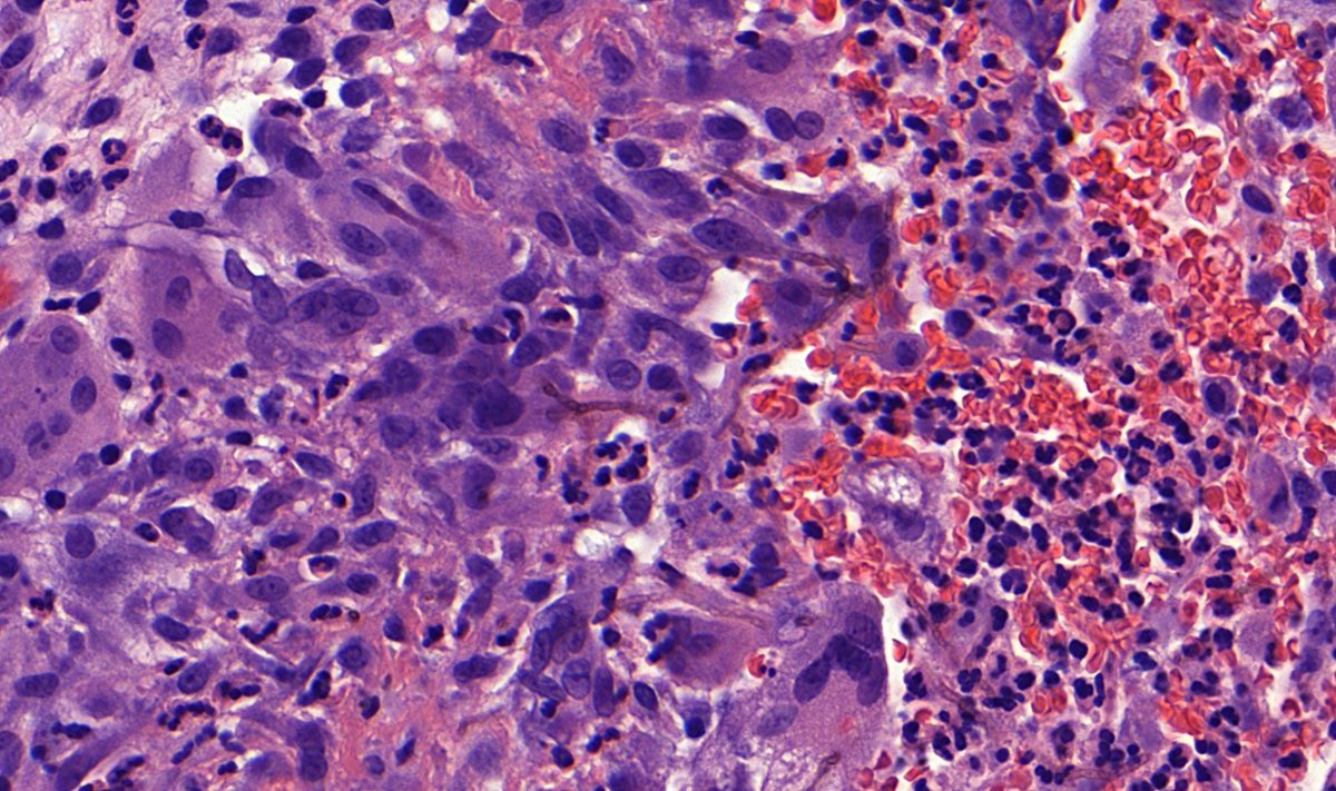 Lower leg, Male

#Dermpath #IDpath #Pathtwitter