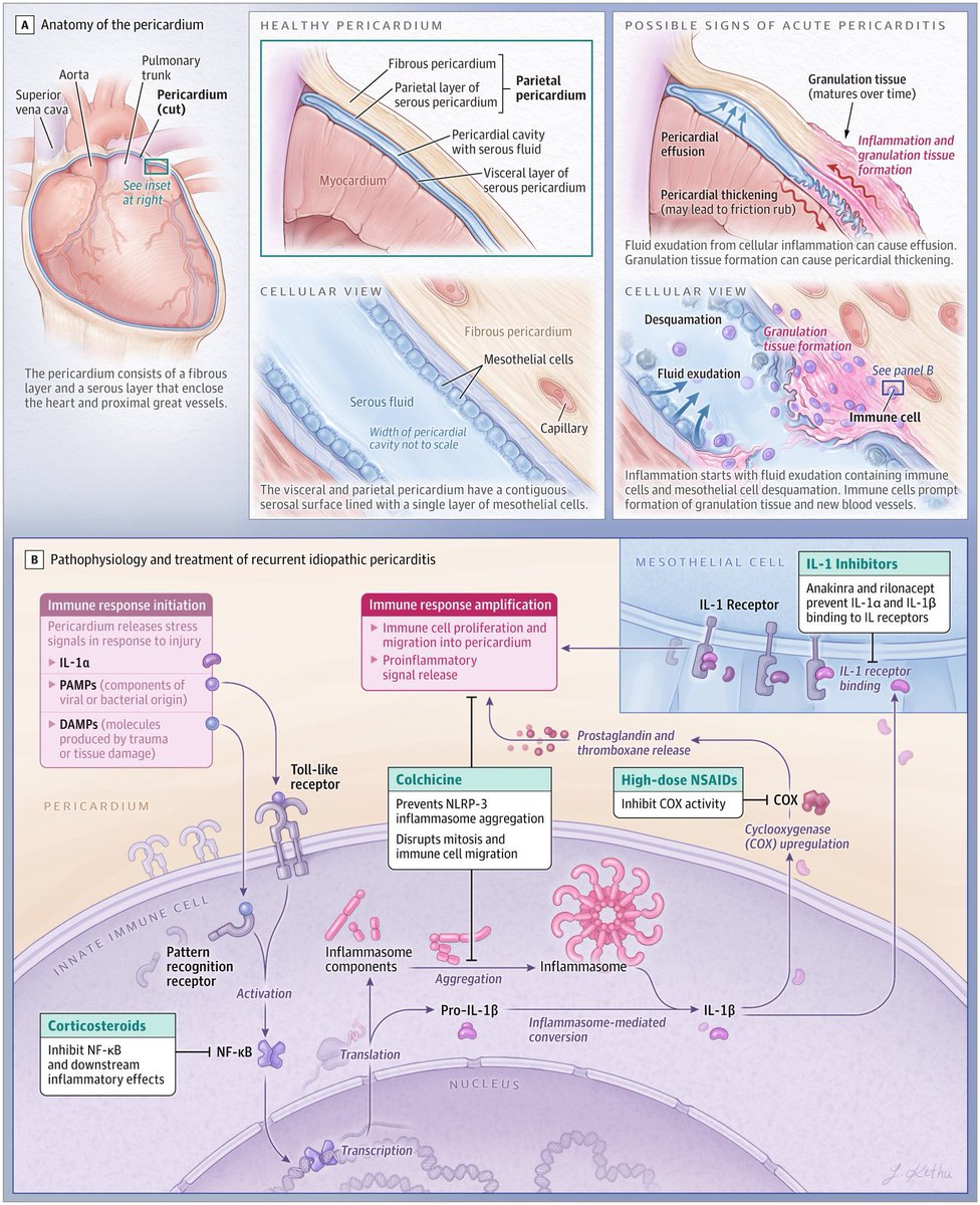 🔴 Diagnosis, Risk Stratification, and Treatment of Pericarditis <a href="/JAMA_current/">JAMA</a> #cardioEd #Cardiology #ENARM #Pericarditis
