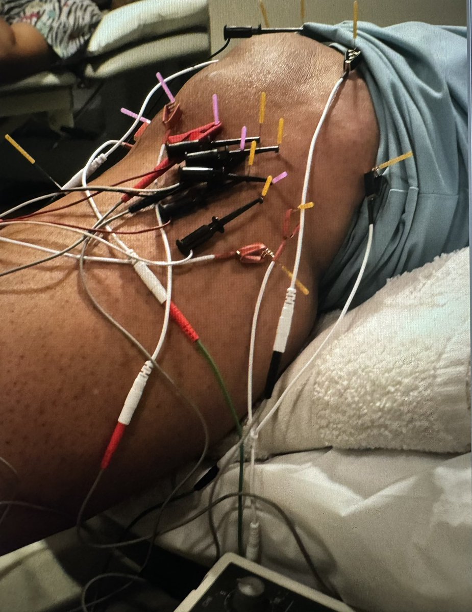 DrDunning's tweet image. I will be presenting the results of the #AAMTFellowship 4-year Knee #Osteoarthritis Dose Interval trial (n=586) at AAOMPT Orlando October 26 @ 8:00 am EST 

Effect of Dose Interval of Periosteal &amp;amp; Intraarticular Electrical Dry Needling on Pain &amp;amp; Disability in Patients with Knee…