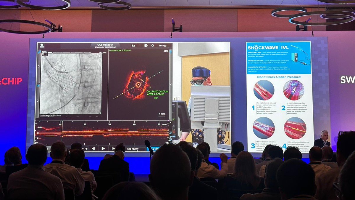 ShockwaveIVL's tweet image. Very nice #RotaShock live case at @SwissCTOCHIP Congress today! 85F patient with severe aortic stenosis and CAD in the LCx. Live from Cheng Hsin General Hospital in Taiwan, Drs Wei-Hsian Yin and Tien-Ping Tsao treated the LCx with rota and #ShockwaveIVL under ECMO support.