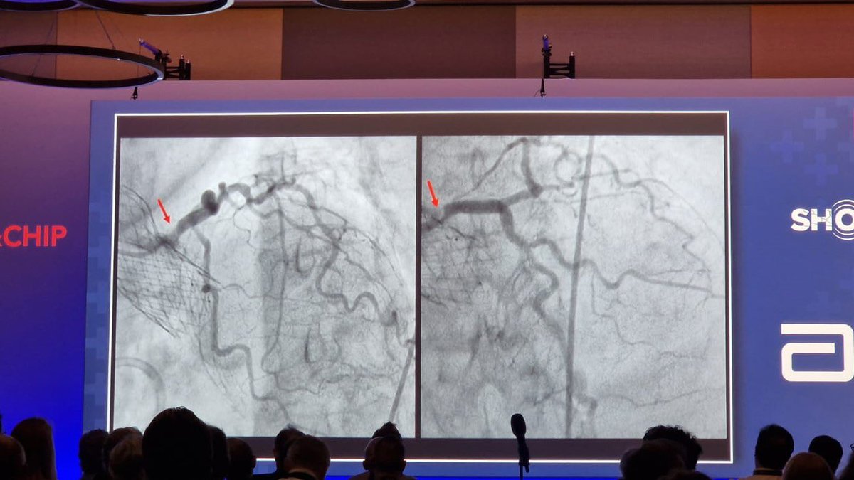 ShockwaveIVL's tweet image. Very nice #RotaShock live case at @SwissCTOCHIP Congress today! 85F patient with severe aortic stenosis and CAD in the LCx. Live from Cheng Hsin General Hospital in Taiwan, Drs Wei-Hsian Yin and Tien-Ping Tsao treated the LCx with rota and #ShockwaveIVL under ECMO support.