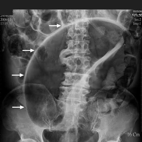 RebMedicina's tweet photo. 📌SIGNO DEL GRANO DE CAFÉ

Característico de volvulo sigmoideo 
.
#meded #medicina #enarm #enarm2024 #medicine #foamed #estudiantemedico #estudiantesdemedicina https://t.co/WSIUXMoaqK