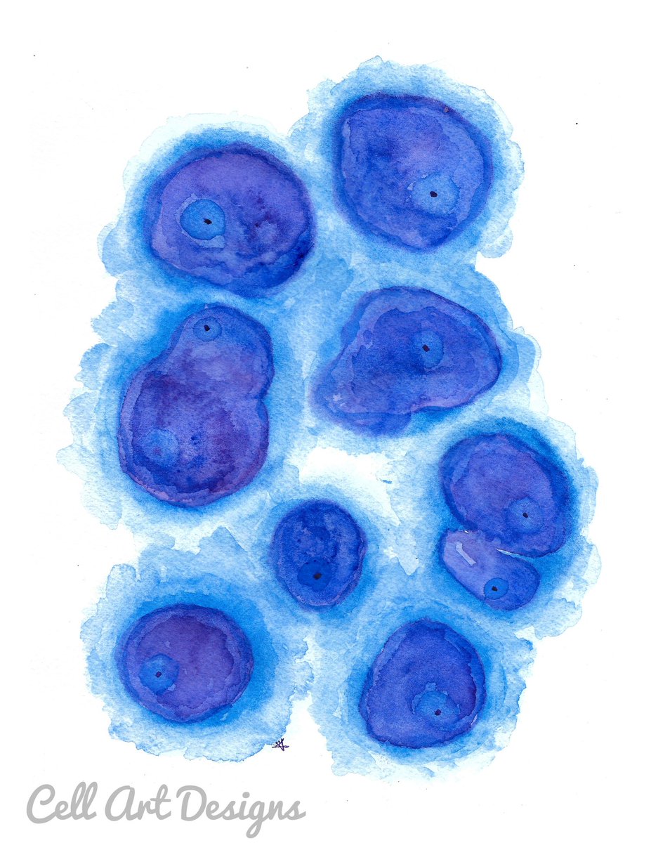 Reactive mesothelial cells are so dramatic but so pretty 🥹. #cytologyisbeautiful #pathart #cytologyart #pathx #pathtwitter