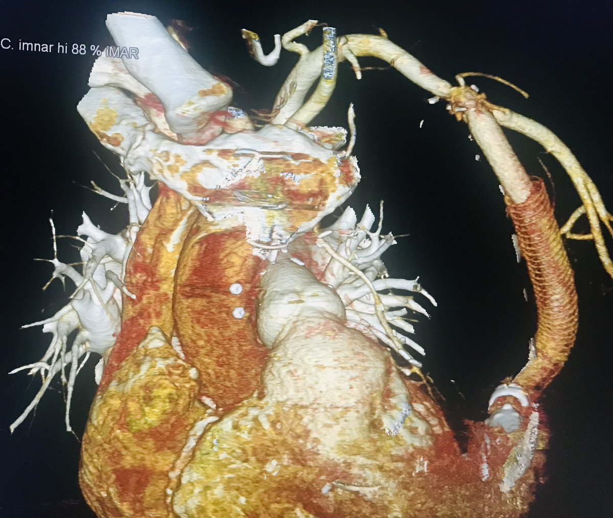 In some cases, particularly #ACHD , alternative configurations for VAD placement are needed. Here is a unique approach where the left subclavian artery was employed as an outflow graft anastomosis site, and the left ventricular apex was approached through a mini-thoracotomy. #VAD