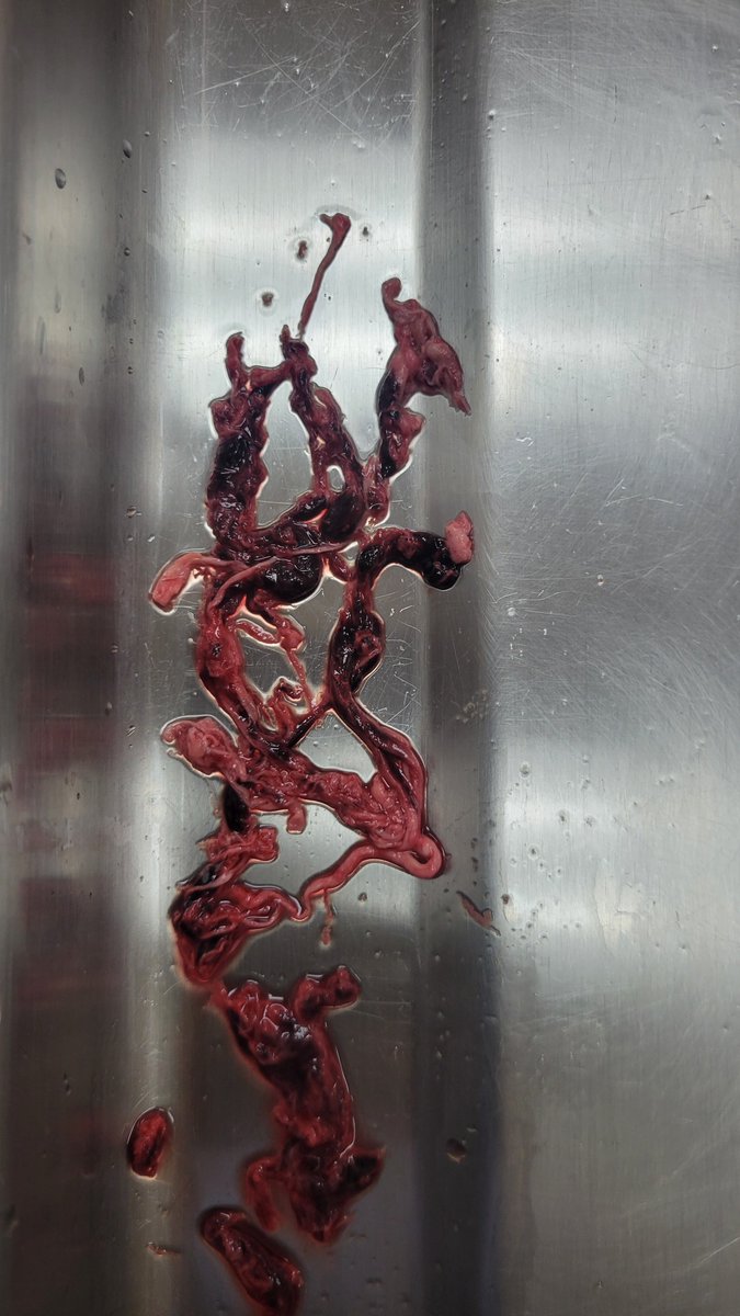 Still happening in September 2024. These are 3 different  cases so far this month. John O'Looney is seeing more of this as well. I got a message from another embalmer from Mississippi saying he's seeing more of it as well.