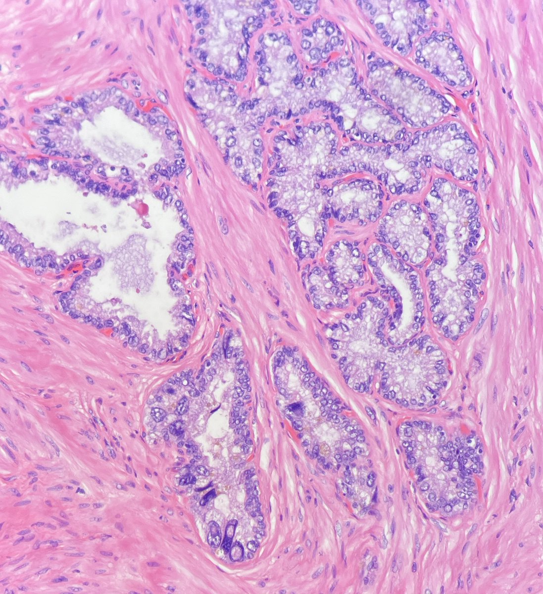 Seminal vesicle nuclei: Too pleomorphic to be prostate cancer