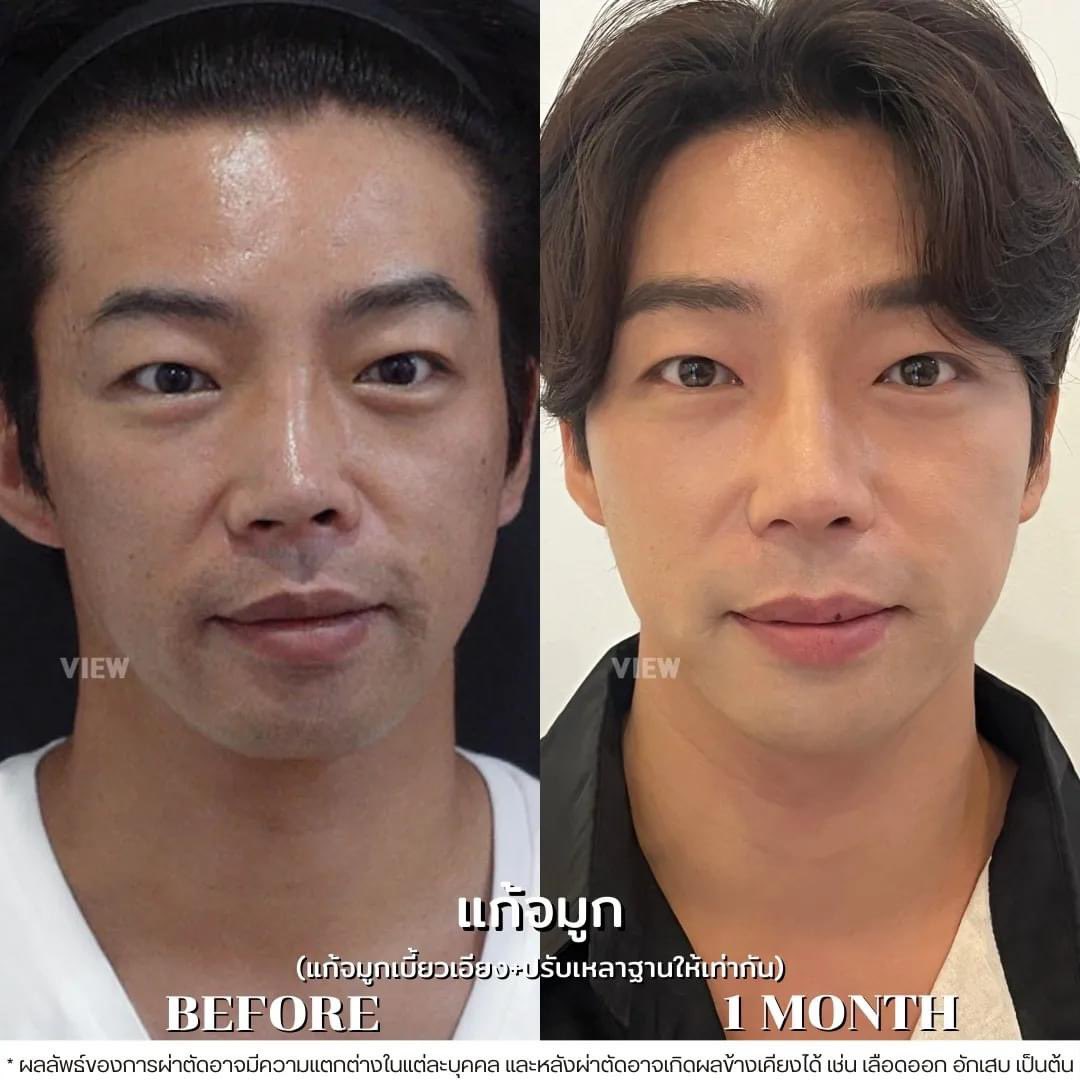 oppamethailand's tweet image. รีวิวเคสแก้จมูกผู้ชายรอบที่ 3 ผลลัพธ์สุดจึ้งงง! ไม่ว่าจะเคสแรกหรือเคสแก้ รพ.วิวจัดให้ตามคำขอ 🎉

ปรึกษาศัลยกรรมเกาหลีได้ที่ LINE @oppame หรือคลิก oppame.com/chat

#oppame  #ที่ปรึกษาศัลยกรรมเกาหลี #อันดับ1 #ศัลยกรรมเกาหลี  #รีวิวศัลยกรรมเกาหลี #โรงพยาบาลศัลยกรรมเกาหลี