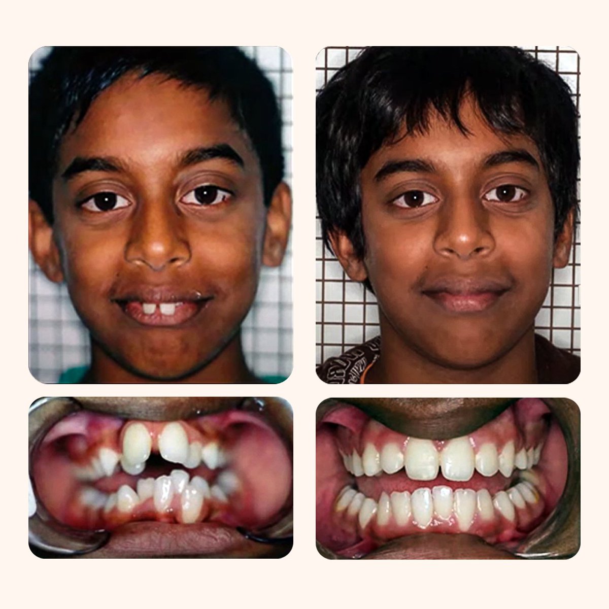 JohnFlutter's tweet image. Dr. Chris Farrell, the founder of Myobrace, reveals how he transformed Rhys's severe oral dysfunction, extreme crowding, and malformed jaws.
Astonishingly, by correcting his craniofacial growth, Rhys ended up looking exactly like his twin brother—without surgery.
Let's see…