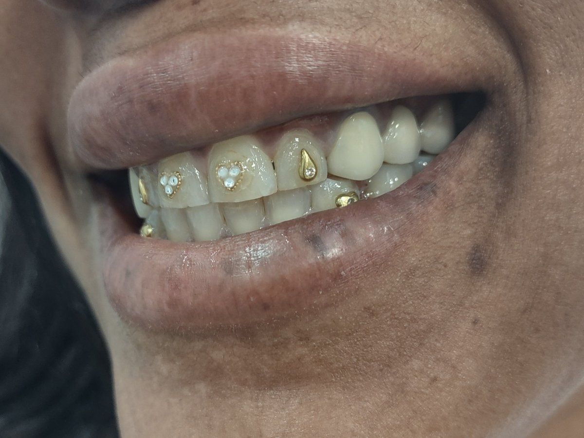 SorrisoD_'s tweet photo. Look at these beautiful gold tooth gems! 
.
Call or text our office at (416) 822-6751 to inquire about our tooth gems!
.
#toothgem #toothgems #gold #goldtooth #dental #dentistry #heart #crystal #diamond https://t.co/9ZxIWoIS7W