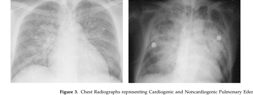Leo_Santo5's tweet photo. 💎 Edema Pulmonar Cardiogénico en Urgencias 🫁🫀

📖Definición
🧬Fisiopatología
🧐Etiologías
🩺Presentación Clínica
🩻Diagnóstico
💉Tratamiento

🔰📚Adv. Respir. Med. 2023

https://t.co/qQ4HFE6do3

Enlace a Artículo Completo 👇🏻✅🆓https://t.co/xumUMHaxVK https://t.co/igOojr6NyX
