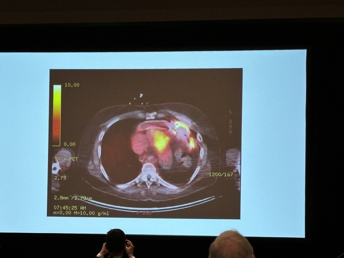 Georgia Vasilakis Tsatiris, MD (@gmvasilakis) on Twitter photo Clinical Case: LVAD infection - eloquently presented by <a href="/nievesra14/">Ricardo Nieves</a> this morning 👏🏻🫀☢️ #ASNC2024 #CVNuc #ThinkPET <a href="/PittCardiology/">Pitt Cardiology</a> Clinical Case: LVAD infection - eloquently presented by <a href="/nievesra14/">Ricardo Nieves</a> this morning 👏🏻🫀☢️ #ASNC2024 #CVNuc #ThinkPET <a href="/PittCardiology/">Pitt Cardiology</a>