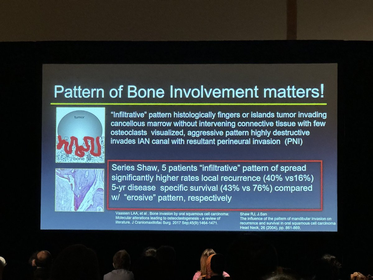 Currently any bone involvement upstages a tumor to T4 but the literature is starting to show the  pattern of bone invasion is what affects prognosis, presented by Dr. Claudia Kirsch during her talk on bone and cartilage invasion. 
#ASHNR24 #HNrad