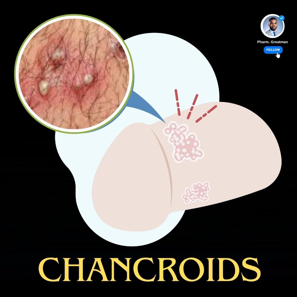CHANCROID

Have you heard of chancroid? 

It’s a painful Sexually Transmitted Disease (STD) that causes sores and swollen lumps in the groin, and it’s more common than you might think. 

This thread explains what it is, how to spot it, and how to stay protected

A thread