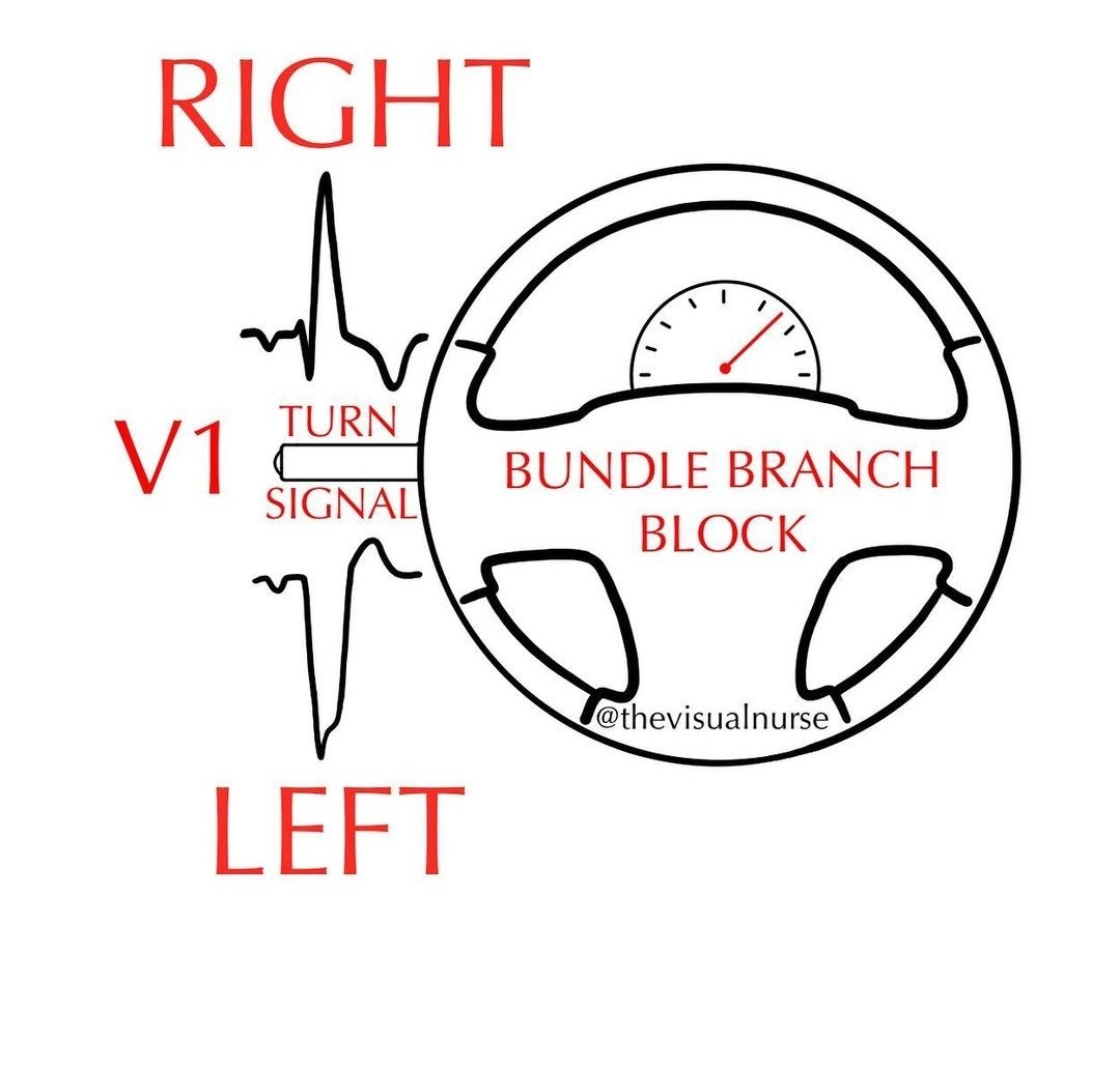 ZHeart11768530's tweet photo. 🔴 BUNDLE BRANCH BLOCK ON THE ECG 📕⤵️ 
🔹 #RBBB #LBBB

 #FOAMed #MedEd #medstudent #paramedic #Cardiology #CardioEd #medtwitter #meded #CardioTwitter #cardiotwiteros  #MedX #cardiovascular #MedTwitter #medical #medEd #cardiotwitter #ECG #ekg https://t.co/A2Fe9dAPST