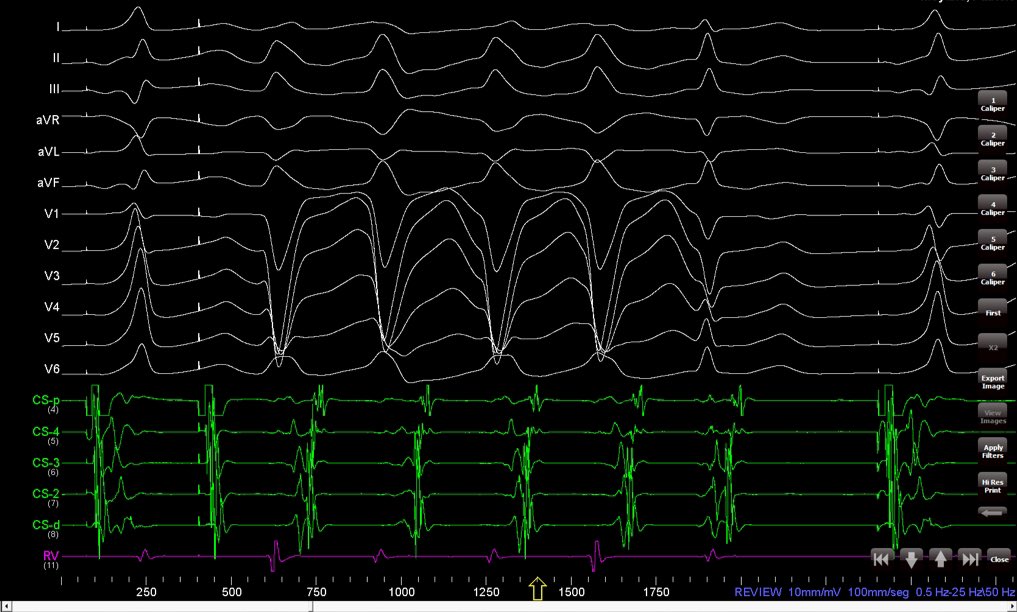 “The Aborted Coumel Sign”

Pleased to meet you!

Recently, I’ve posted a WCT that was terminated w/narrow complex
QRS in a treadmill test. We weren’t able to reproduce it in the EPS but our thoughts were right. It was a left sided AP

Today in other #WPW RFA the sign was seen.
