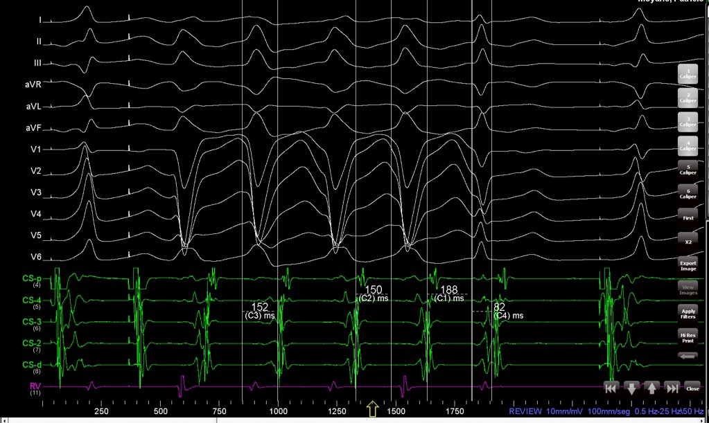 It is really easy to understand.
WCT has a longer VA than NCT. When LBBB resolves, VA is shorter and AH longer, producing AV block after first beat after QRS normalization.
In this case, there is no His.
Measurements are made from CS no QRS onset.