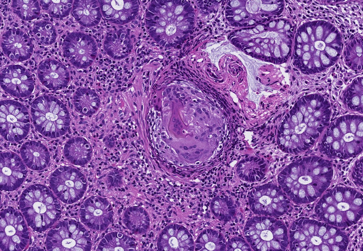 Incidental epithelioid granuloma with giant cells in a colon biopsy. What a beauty!