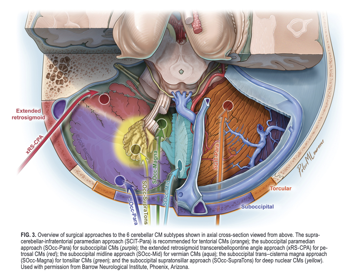 #OnlineFirst: A taxonomy for cerebellar cavernous malformations: subtypes of cerebellar lesions. 

thejns.org/view/journals/….