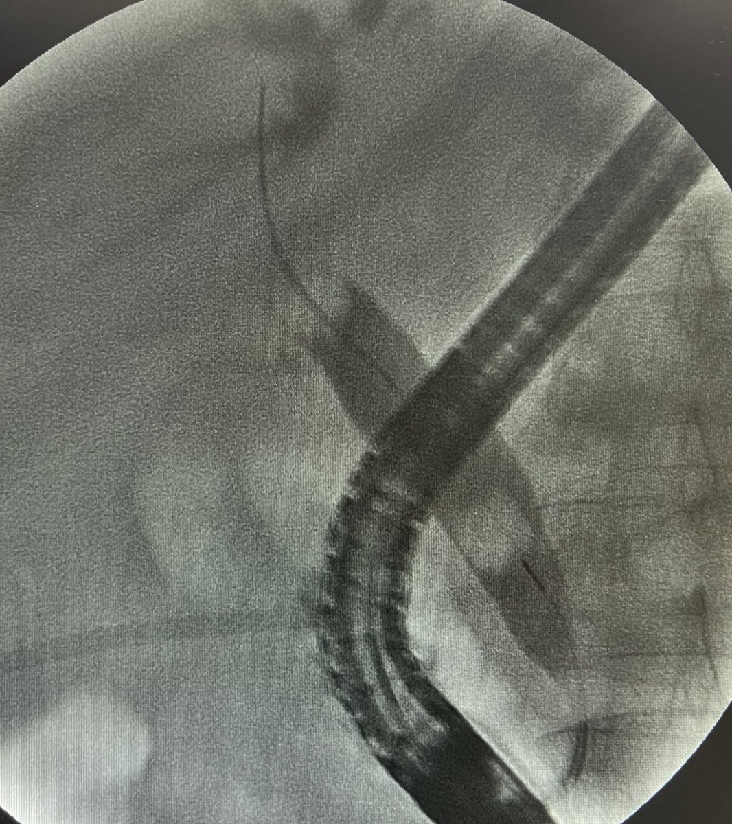 Liver_guy's tweet photo. @DouglasAdlerMD Amen to that - a likely story in the cholangiogram last night👇🏼 https://t.co/CCas8pKnUs