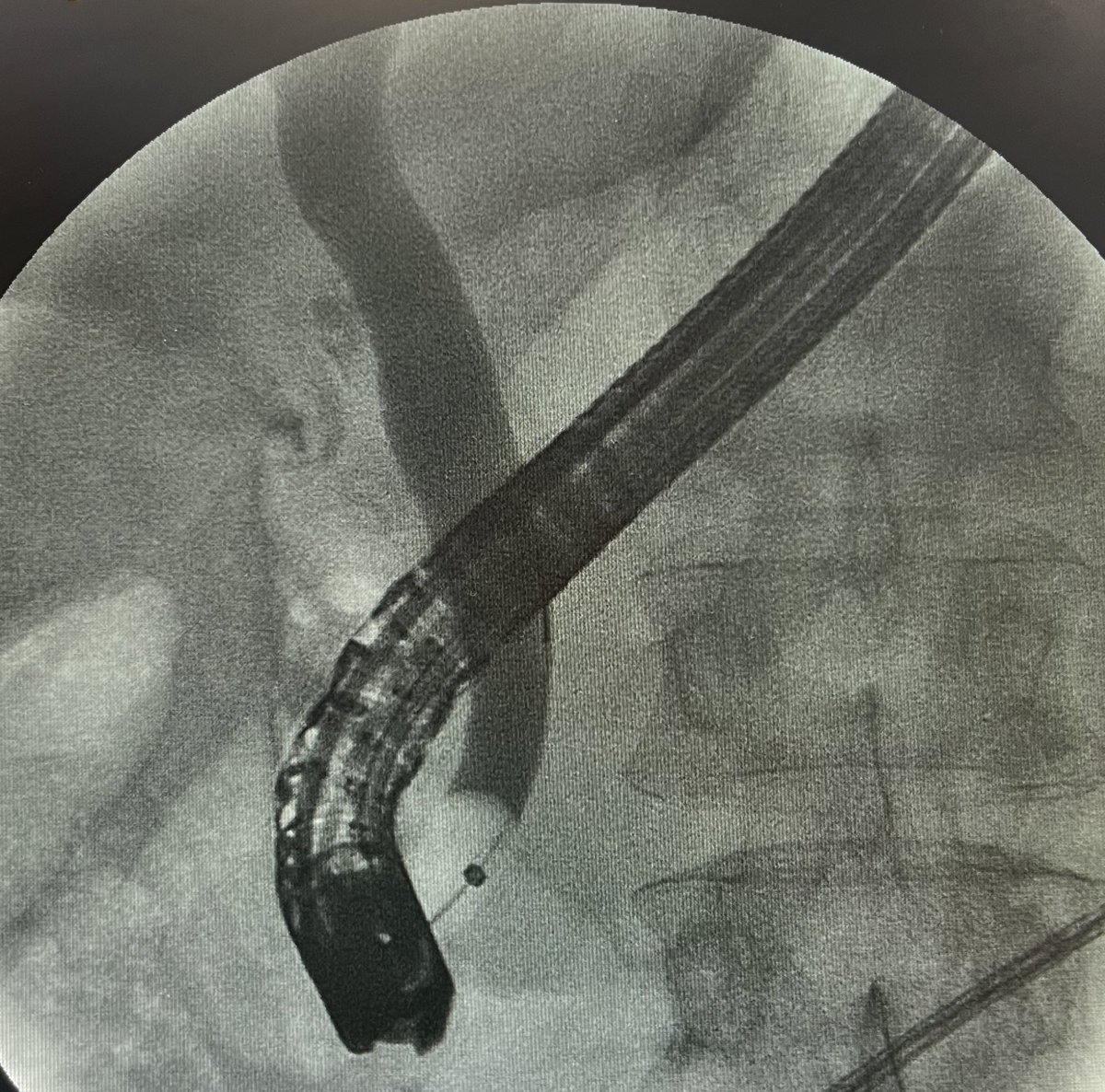 Liver_guy's tweet photo. @DouglasAdlerMD Amen to that - a likely story in the cholangiogram last night👇🏼 https://t.co/CCas8pKnUs