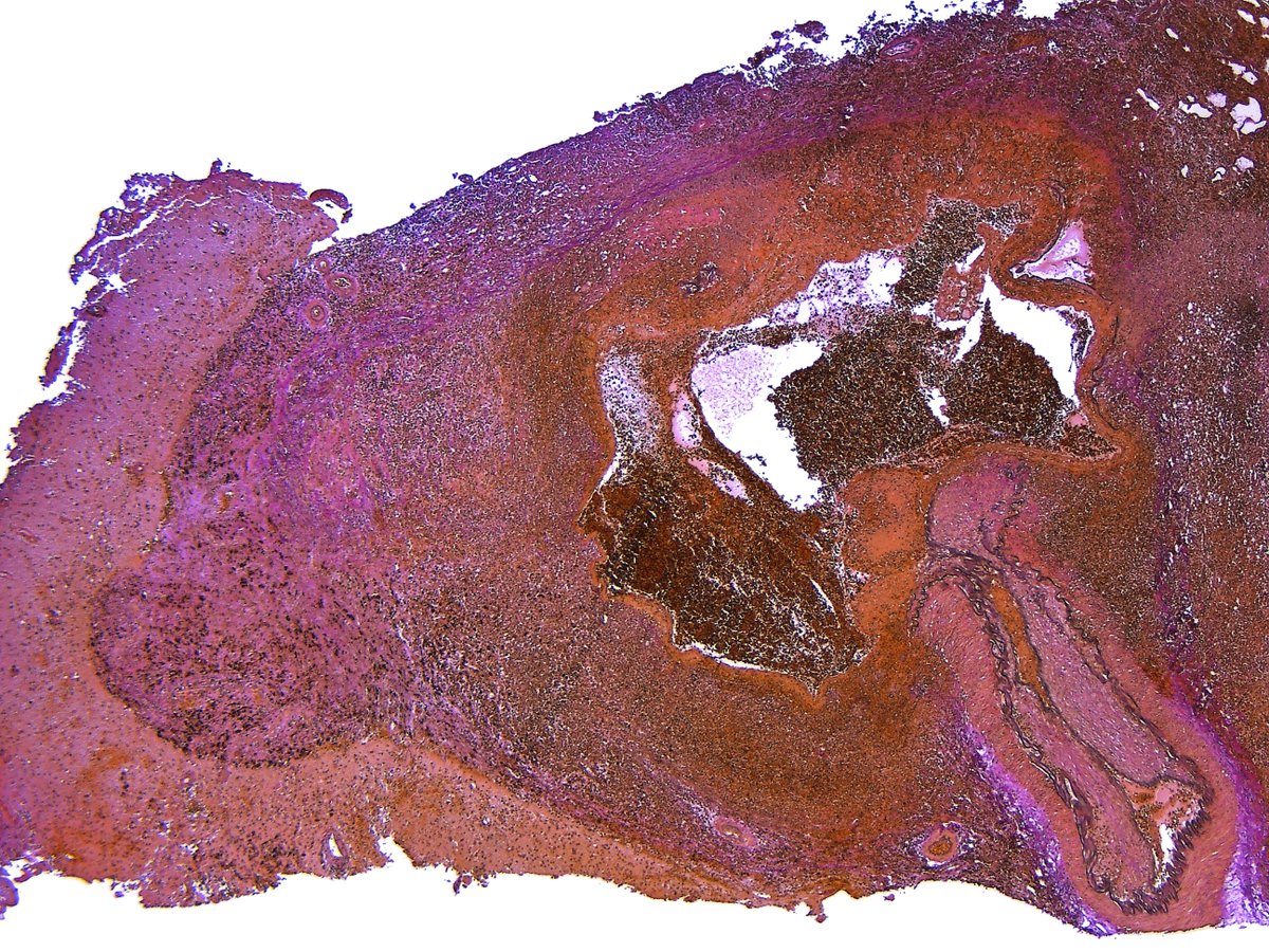 Pathology Walker@Auto Tweet Bot tweet media