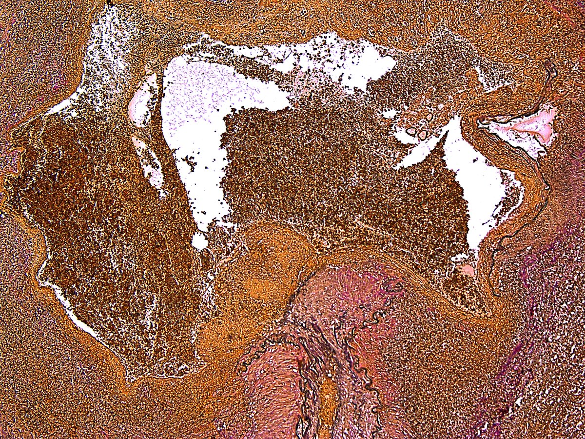 Pathology Walker@Auto Tweet Bot tweet media