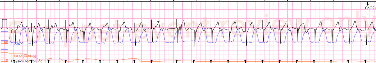 Joshua Kimbrell (@joshkimbre) on Twitter photo New blog post up on <a href="/EMS12Lead/">EMS 12-Lead</a> from <a href="/JMedic2JDoc/">Judah Kreinbrook</a> and myself on TCP in a patient with Complete Heart Block and Altered Mental Status.
Give it a quick read: ems12lead.com/post/transcuta… New blog post up on <a href="/EMS12Lead/">EMS 12-Lead</a> from <a href="/JMedic2JDoc/">Judah Kreinbrook</a> and myself on TCP in a patient with Complete Heart Block and Altered Mental Status.
Give it a quick read: ems12lead.com/post/transcuta…