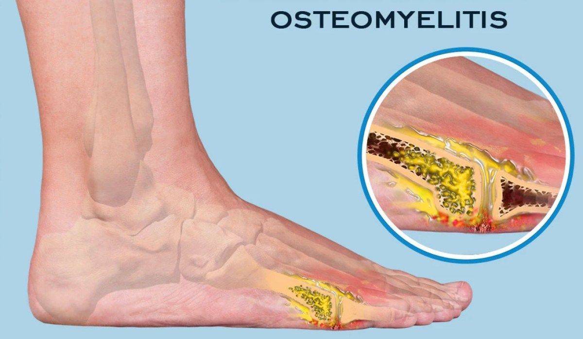 Three versus six weeks of antibiotic therapy for diabetic foot osteomyelitis: A prospective, randomized, non-inferiority pilot trial – DF Blog diabeticfootonline.com/2020/11/29/thr…