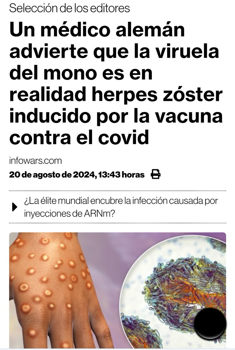 El Dr. alemán Wolfgang Wodarg apareció recientemente en una entrevista en la que sugirió que el actual bombo publicitario sobre la viruela del mono no es más que una estrategia alarmista por parte del establishment globalista corrupto que intenta encubrir los síntomas de las
