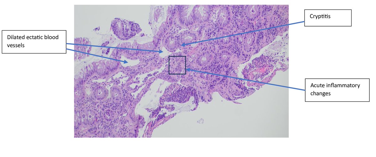 A 45-year-old woman with cervical carcinoma underwent radiation therapy and subsequently developed radiation colitis. Histopathology reveals mucosal atrophy, crypt distortion, and inflammatory infiltrates. #RadiationTherapy #CervicalCancer #RadiationColitis #PathTwitter