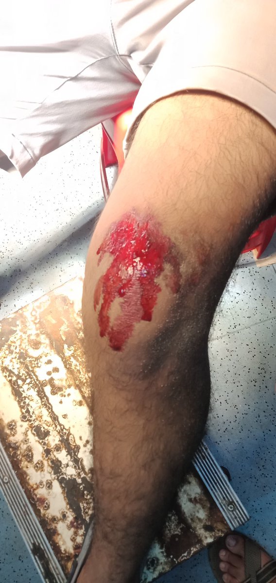 docman_nhk's tweet photo. It is a grave irony of #RIMS,Ranchi that the security home guards threaten&amp; attempt to kill the students after drinking alcohol

Students sustained severe injuries like fracture in Zygomatic bone &amp; blood in maxillary sinus.

There is an urgent call for the  Central protection Act https://t.co/eVaIrcDZ3y