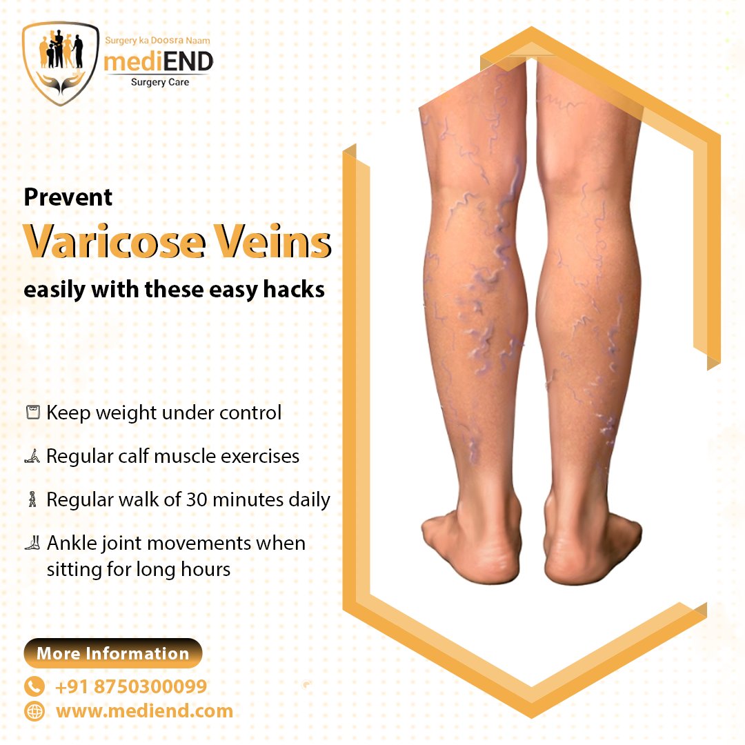 medi_end_'s tweet photo. Get rid of #varicoseveins with expert care in Hyderabad at mediEND Surgery Care!
Book your appointment now: https://t.co/j2uFWEGviV
.
.
.
.
#Health #healthcare #mediend #mediendsurgery #treatment #varicose #weightundercontrol #regularwalk #muscleexercises #anklejointmovement https://t.co/Wggobd3010