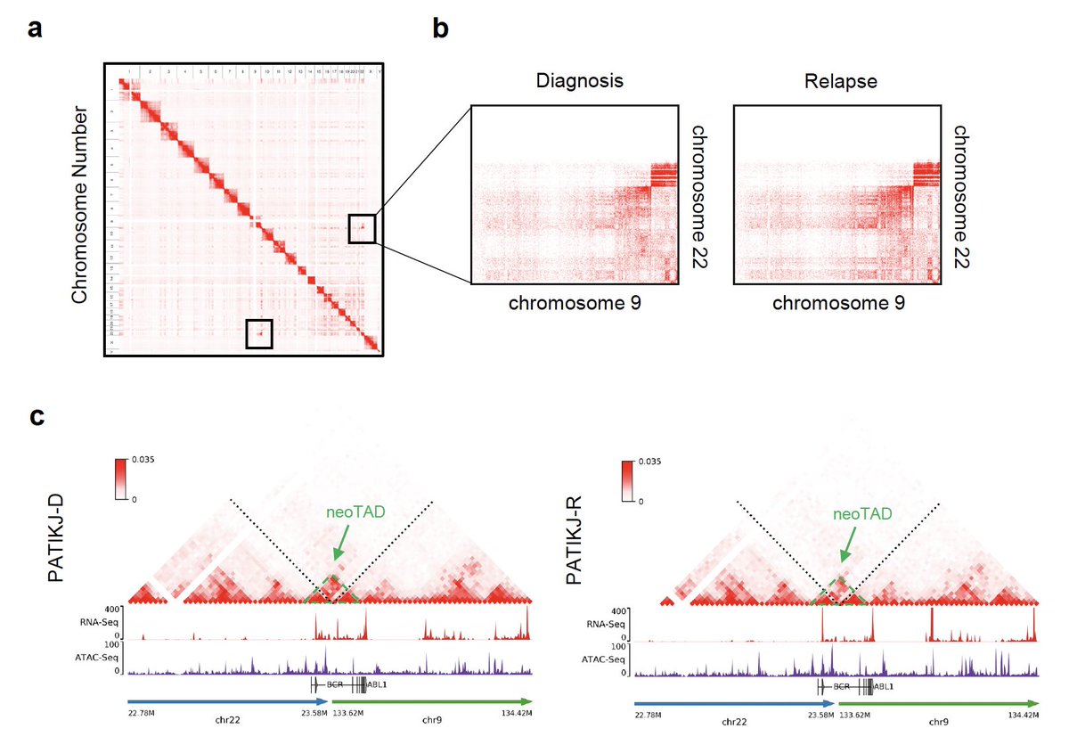 Iannis Aifantis (@iannisaifantis1) on Twitter photo Out today our 3D chromosomal landscape "evolution" paper in pediatric B cell leukemia (B-ALL). We report extensive Hi-C, ATAC- & RNA-seq on matched diagnosis/relapse B-ALL specimens. Work by the fantastic <a href="/__YGhe/">Yohana Ghebrechristos</a> and <a href="/SonaliNarang9/">Sonali Narang</a> at <a href="/NYUGSOM_Path/">NYU GSOM Pathology</a> and <a href="/nyugrossman/">NYU Grossman School of Medicine</a> <a href="/NatureComms/">Nature Communications</a> Out today our 3D chromosomal landscape "evolution" paper in pediatric B cell leukemia (B-ALL). We report extensive Hi-C, ATAC- & RNA-seq on matched diagnosis/relapse B-ALL specimens. Work by the fantastic <a href="/__YGhe/">Yohana Ghebrechristos</a> and <a href="/SonaliNarang9/">Sonali Narang</a> at <a href="/NYUGSOM_Path/">NYU GSOM Pathology</a> and <a href="/nyugrossman/">NYU Grossman School of Medicine</a> <a href="/NatureComms/">Nature Communications</a>