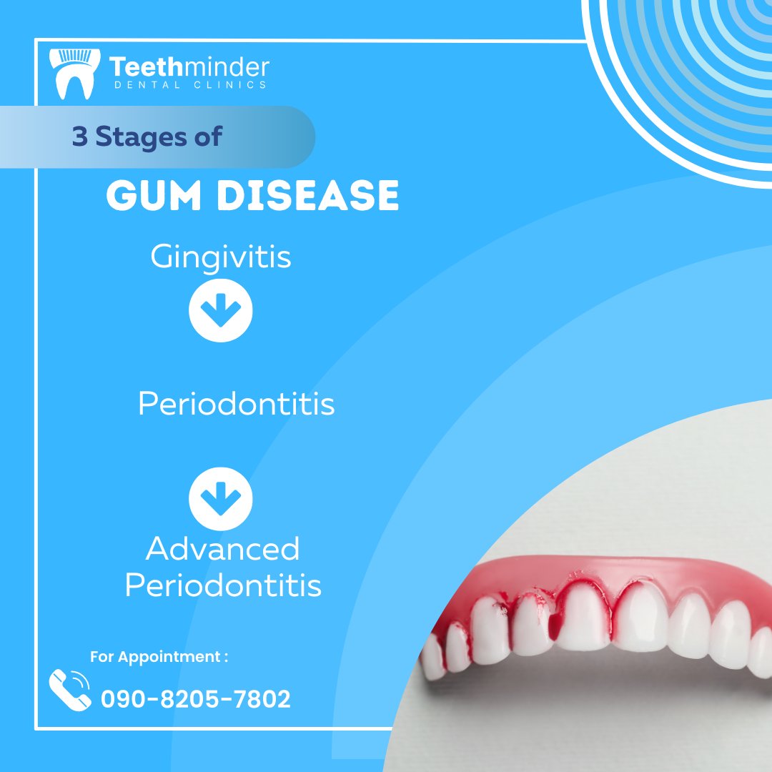 teethminder's tweet photo. Bleeding gums? It could be gingivitis. Brush, floss, use mouthwash, eat well, and stay hydrated. Quit smoking and see your dentist regularly. Keep your smile healthy! 

#OralHealth #GumCare #Teethminder https://t.co/k1eiNYpwOS