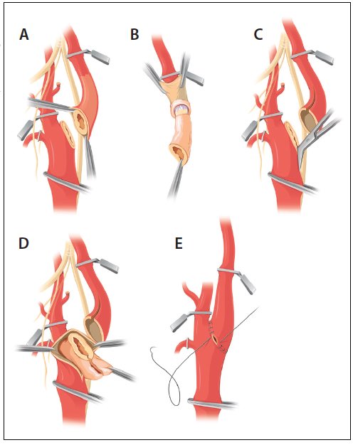 PipeCabreraV's tweet image. Simulate one thousand, see one, do one and teach one 💥⤵️🔪👁️📍! The carotid eversión endarterectomy example! #SoMe4Surgery @monteromiguel @docpark @jmills1955 @pferrada1 @TomVargheseJr