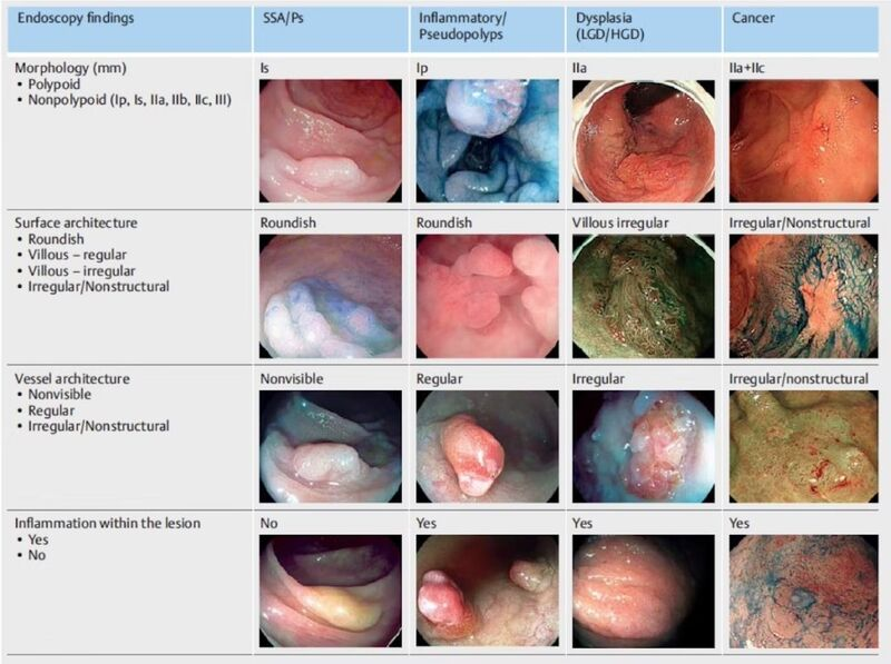 EndoCollabcom's tweet photo. FACILE Classification: A New Era in IBD:

• Internationally developed
• Thoroughly tested system
• Detecting IBD-linked neoplasia via optics https://t.co/Tr0JZ9Pgf3
