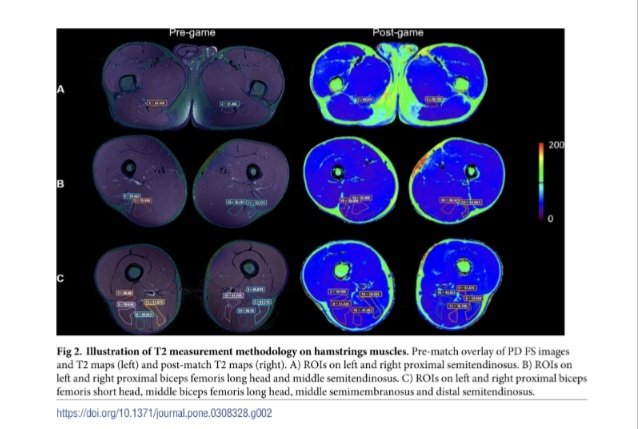 ⚽📊 Characterization of acute effects of football competition on hamstring muscles by muscle functional MRI techniques

pubmed.ncbi.nlm.nih.gov/39190697/