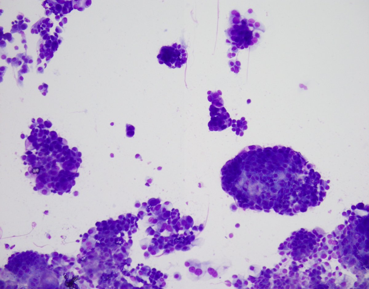 UABPathology's tweet photo. #UABCyto case by Dr. Brooke Bartow: 61yoF w/ endometrial polyp. Peritoneal fluid shows clusters of abnormal cells w/ pleomorphism and prominent nucleoli + for Moc31, Ber-EP4, Pax8 and mutant expression of p53. Dx: adenocarcinoma of mullerian origin, consistent w/ serous carcinoma https://t.co/d9VCmvxpzq