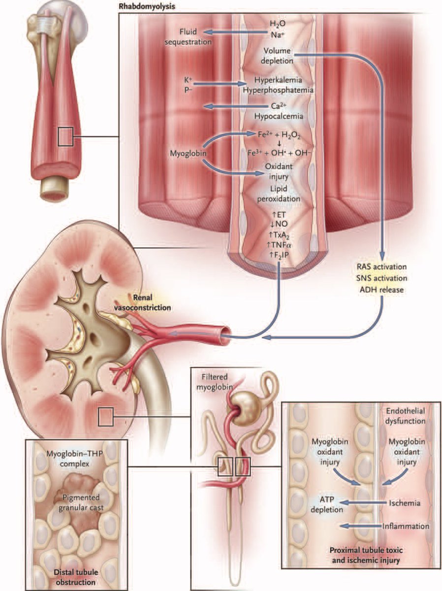 AmbrizMau's tweet photo. Mecanismos fisiopatológicos de la lesión renal aguda inducida por rabdomiólisis:

N Engl J Med 2009;361:62­72. https://t.co/fksywHFuz8