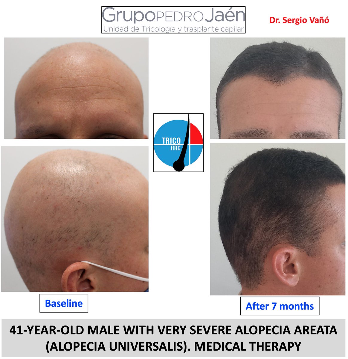 De vuelta al trabajo y con grandes satisfacciones viendo cómo los avances científicos permiten mejorar la calidad de vida a nuestros pacientes con diferentes formas de alopecia! 🔝

#TricoHRC #GrupoPedroJaen